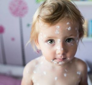 La varicelle chez l'enfant - L'avis du pédiatre